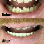 Instant Smile Handmade Bright White Lower Veneer