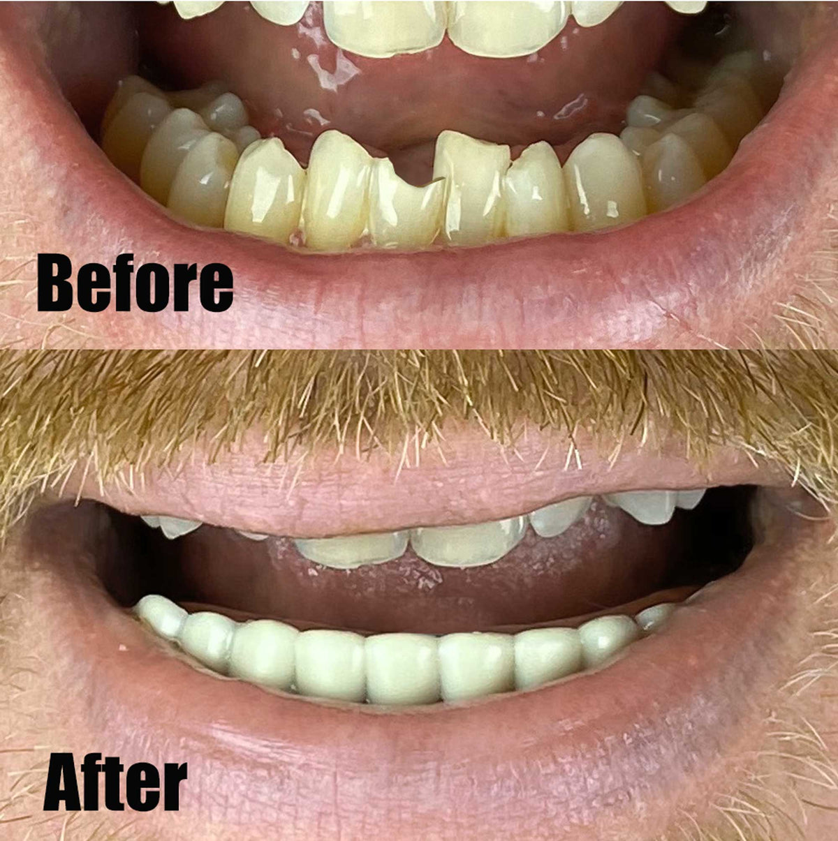 Instant Smile Handmade Bright White Lower Veneer