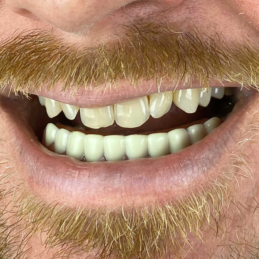 Instant Smile Handmade Bright White Lower Veneer
