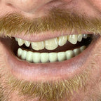 Instant Smile Handmade Bright White Lower Veneer