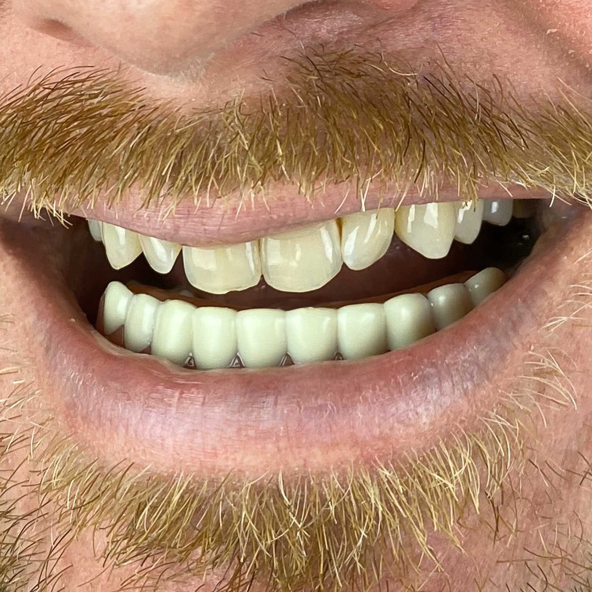 Instant Smile Handmade Bright White Lower Veneer