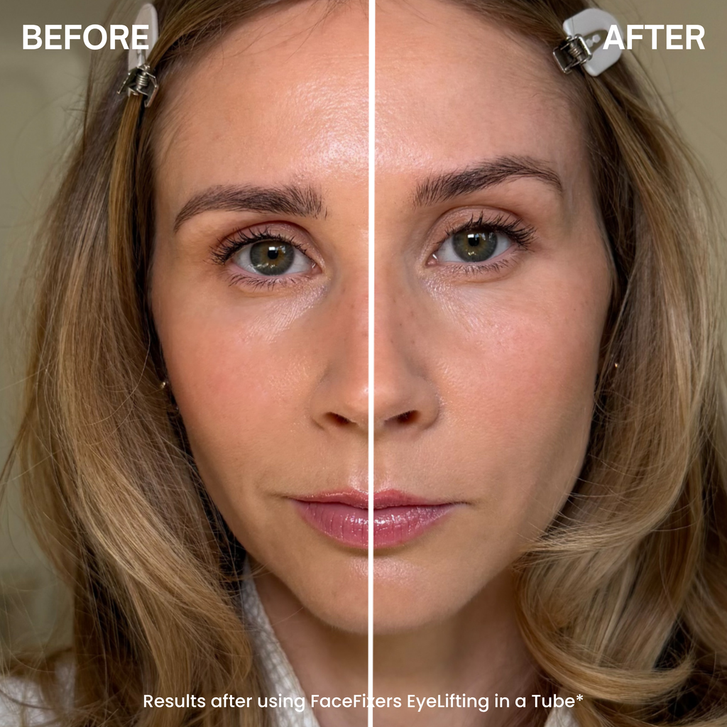 Before and after comparison of a woman's face showing the effect of a facefilter eyelifting treatment. The left side is labeled 'BEFORE' and shows natural skin texture and wrinkles.