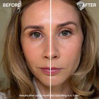 Before and after comparison of a woman's face showing the effect of a facefilter eyelifting treatment. The left side is labeled 'BEFORE' and shows natural skin texture and wrinkles.