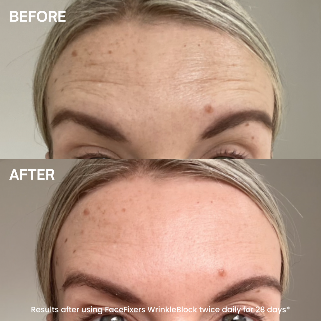 Before-and-after comparison of a woman's forehead showing skin texture and wrinkle improvement, with the text 'BEFORE' and 'AFTER' and a small caption at the bottom.