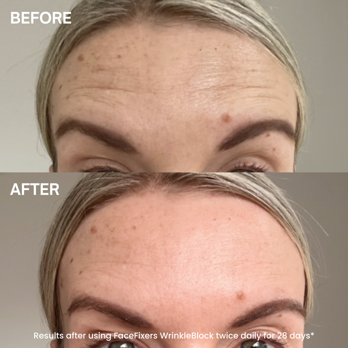 Before-and-after comparison of a woman's forehead showing skin texture and wrinkle improvement, with the text 'BEFORE' and 'AFTER' and a small caption at the bottom.