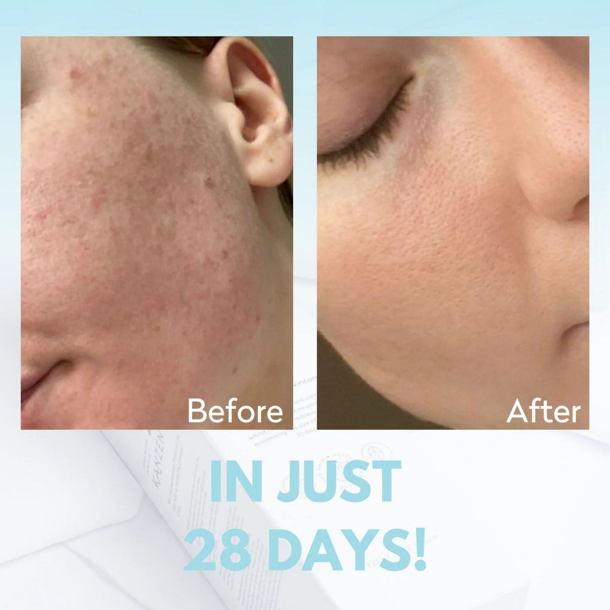 Before and after images using hypochlorous water.