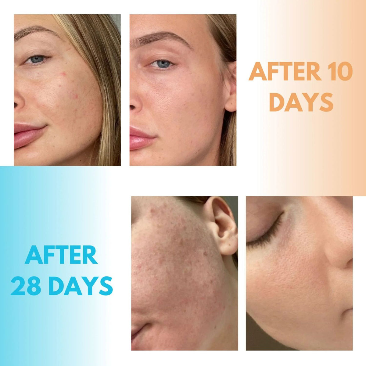 Kanzen Skincare Derma Acne Duo - Cleansing Water & Pore Purifier