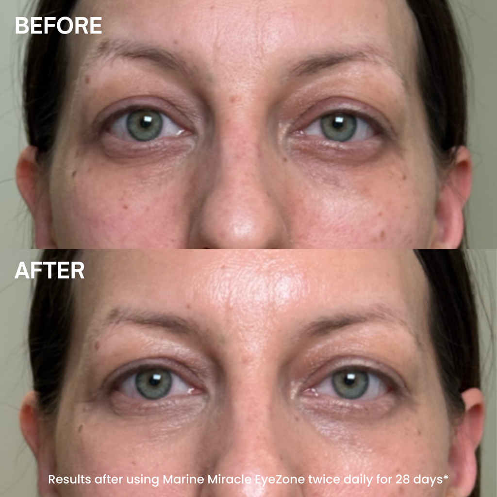 Before-and-after comparison of a woman's eyes and under-eye area, showing a reduction in dark circles and bags under the eyes after using Marine Miracle EyeZone twice daily for 28 days.