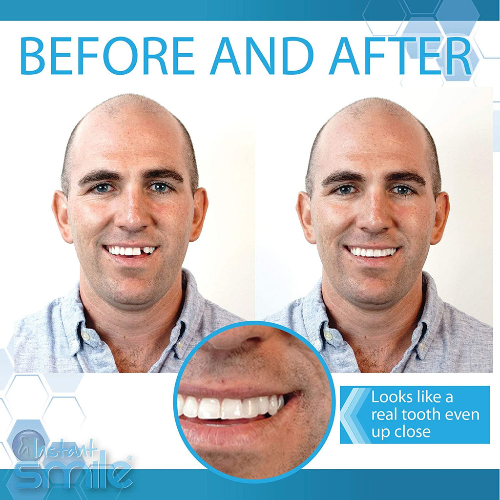 Instant Smile Temporary Tooth Replacement Kit