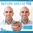 Instant Smile Temporary Tooth Replacement Kit