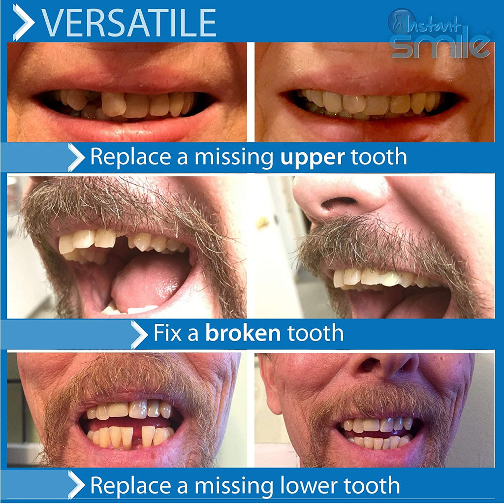 Instant Smile Pro Series Temporary Tooth Replacement Kit