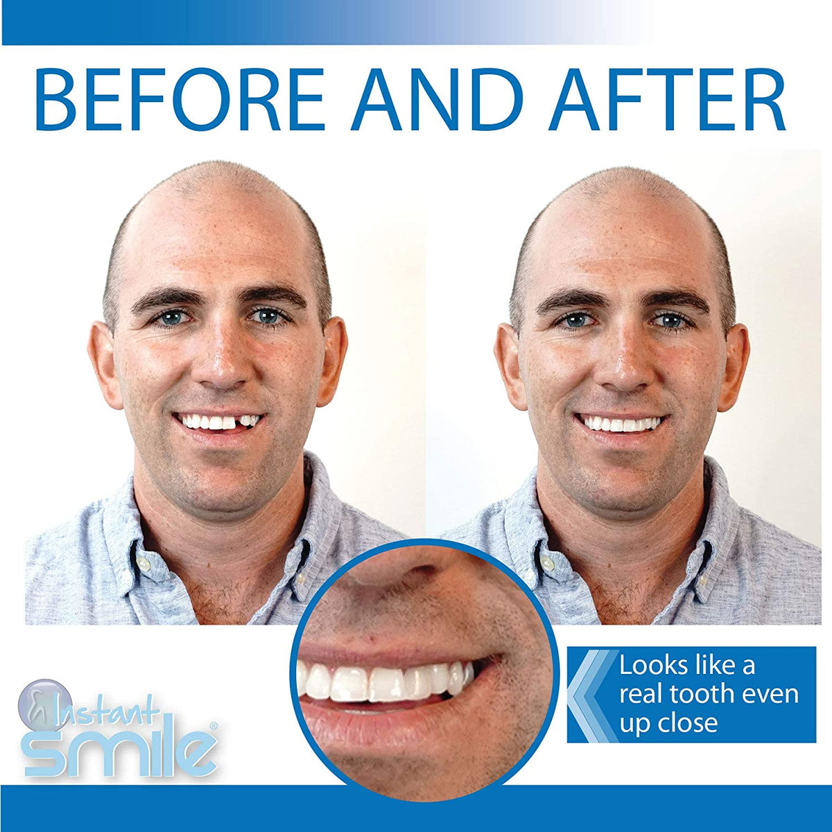 Instant Smile Pro Series Temporary Tooth Replacement Kit